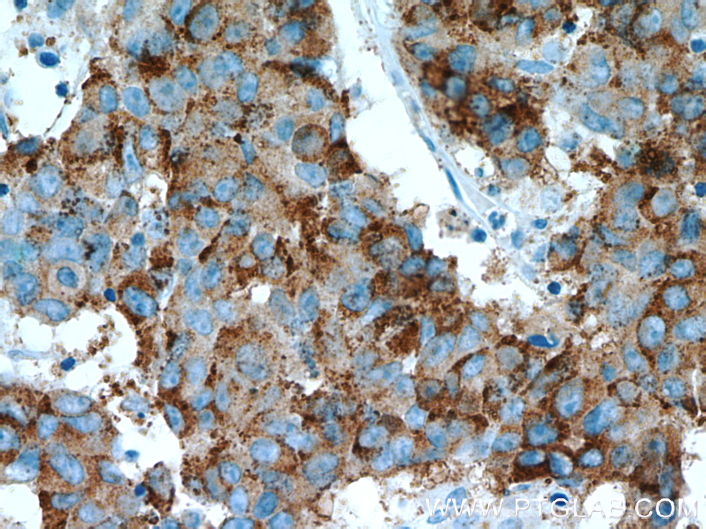 15918-1-AP;human prostate cancer tissue