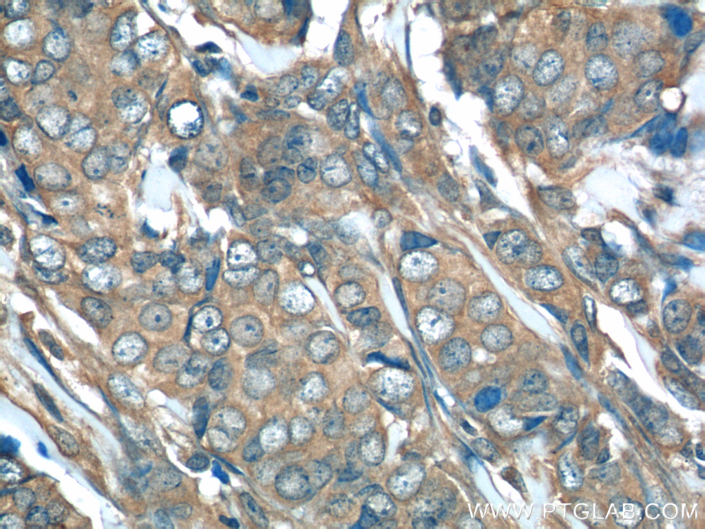 14485-1-AP;human breast cancer tissue