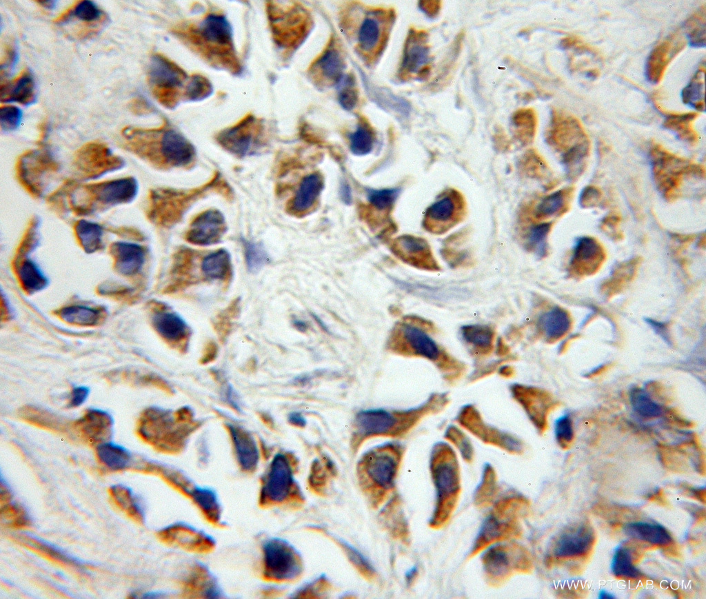 IHC staining of paraffinembedded human prostate cancer using P2RX7 antibody (11144-1-AP) at a dilution of 1:50 (10x objective)