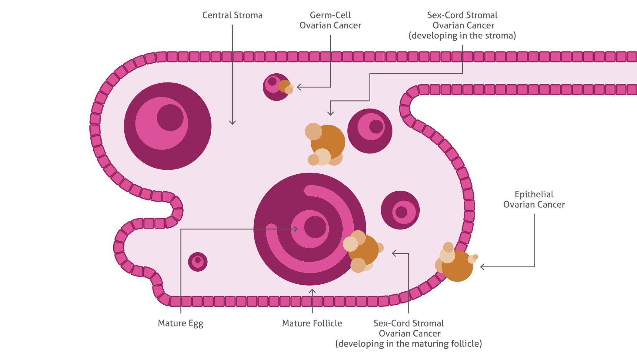 Schema of the ovary showing the histopathological types of ovarian cancer. Epithelial ovarian cancer is the most common cause.