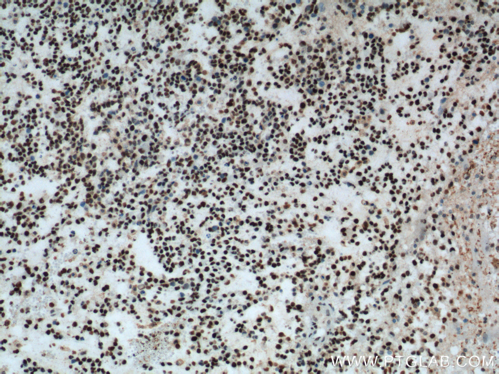 Immunohistochemical staining of paraffin-embedded human gliomas tissue slide using FUS/TLS antibody