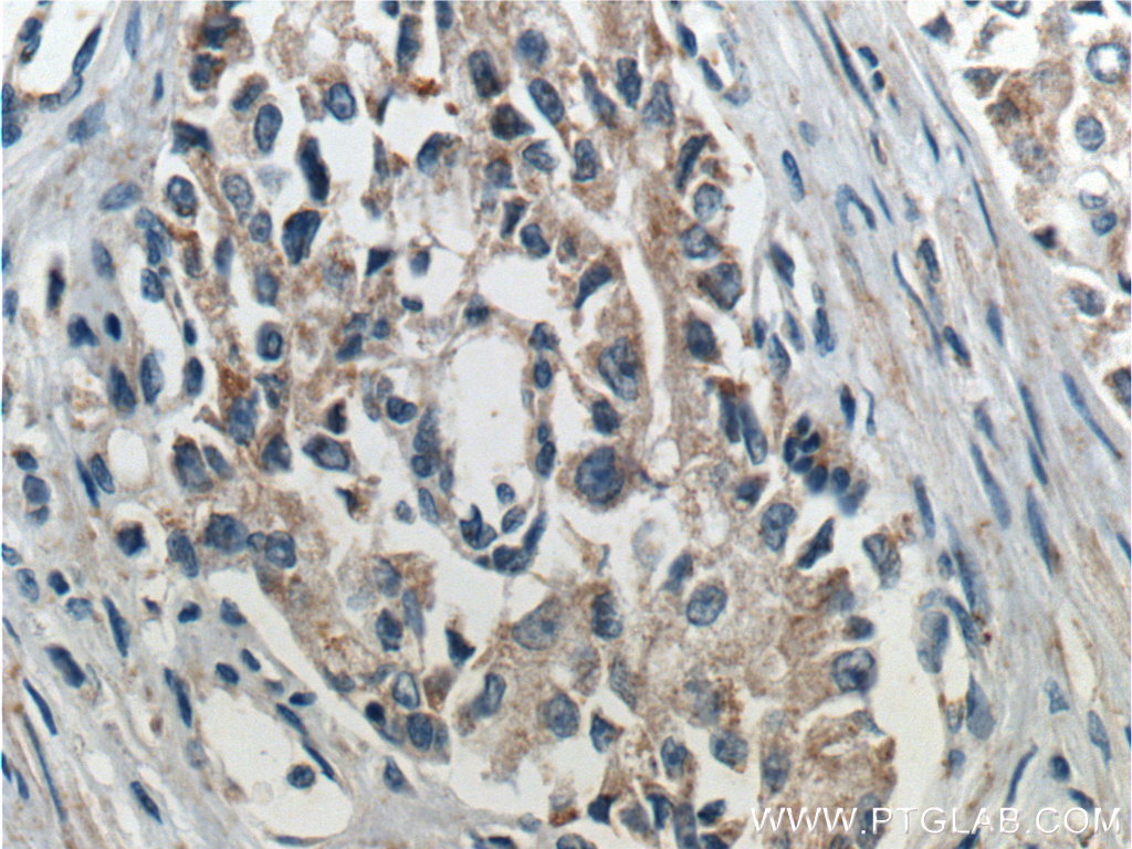 Immunohistochemistry of paraffin-embedded human prostate cancer tissue slide using PTEN antibody