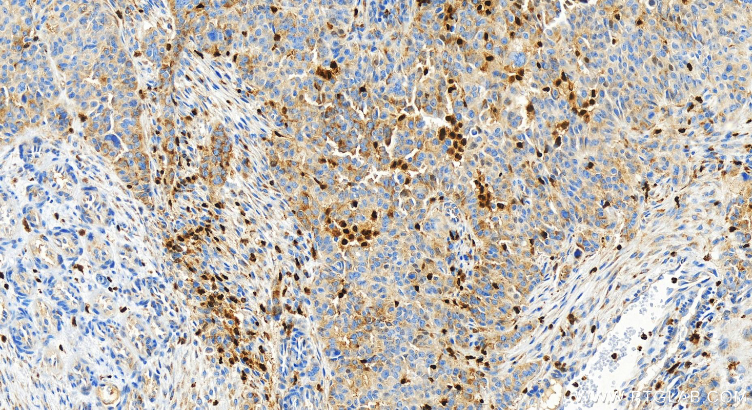 IHC staining of human ovarian  cancer using 83794-4-RR (same clone as 83794-4-PBS)