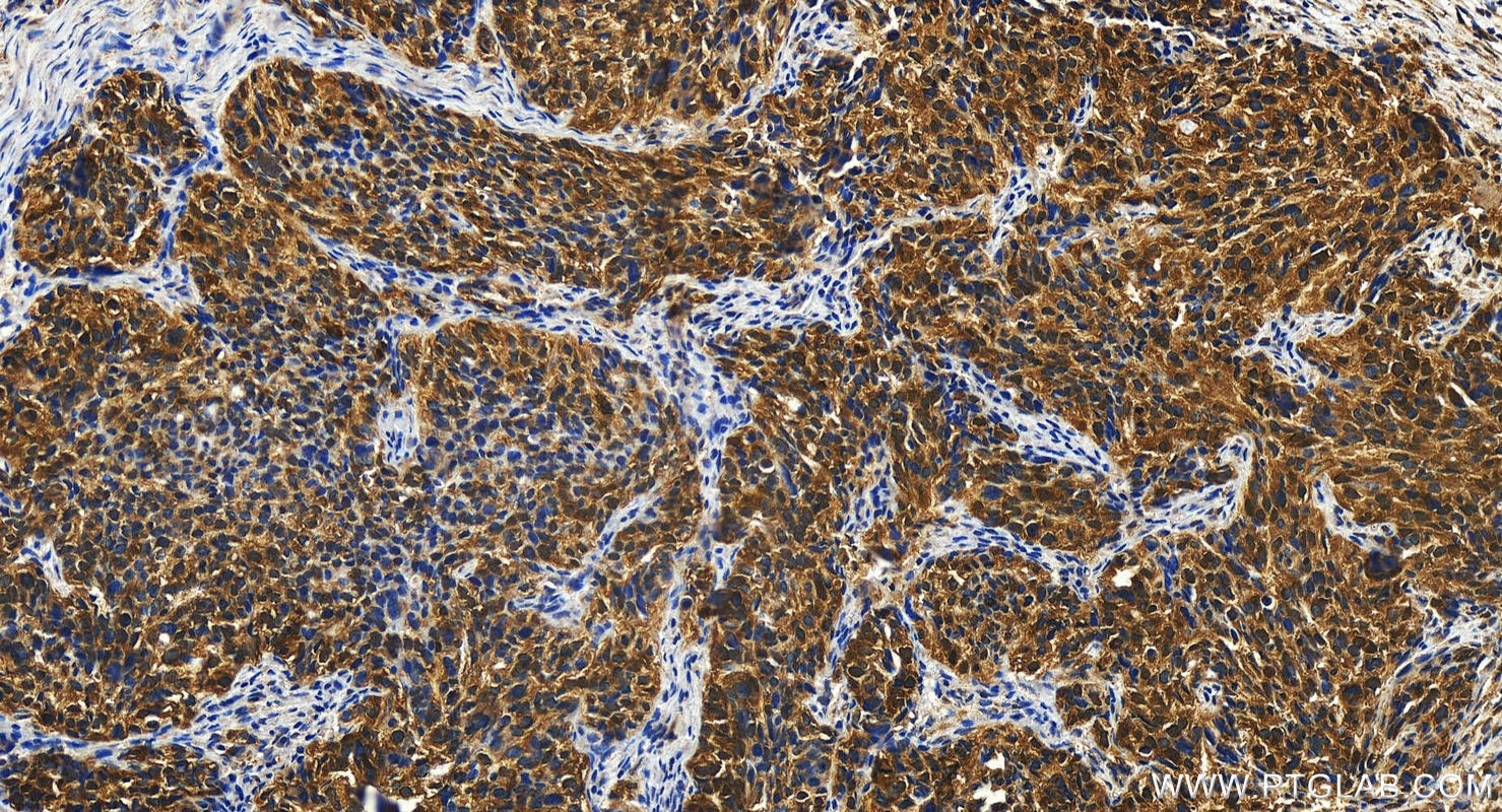 IHC staining of human ovary cancer using 13815-1-AP