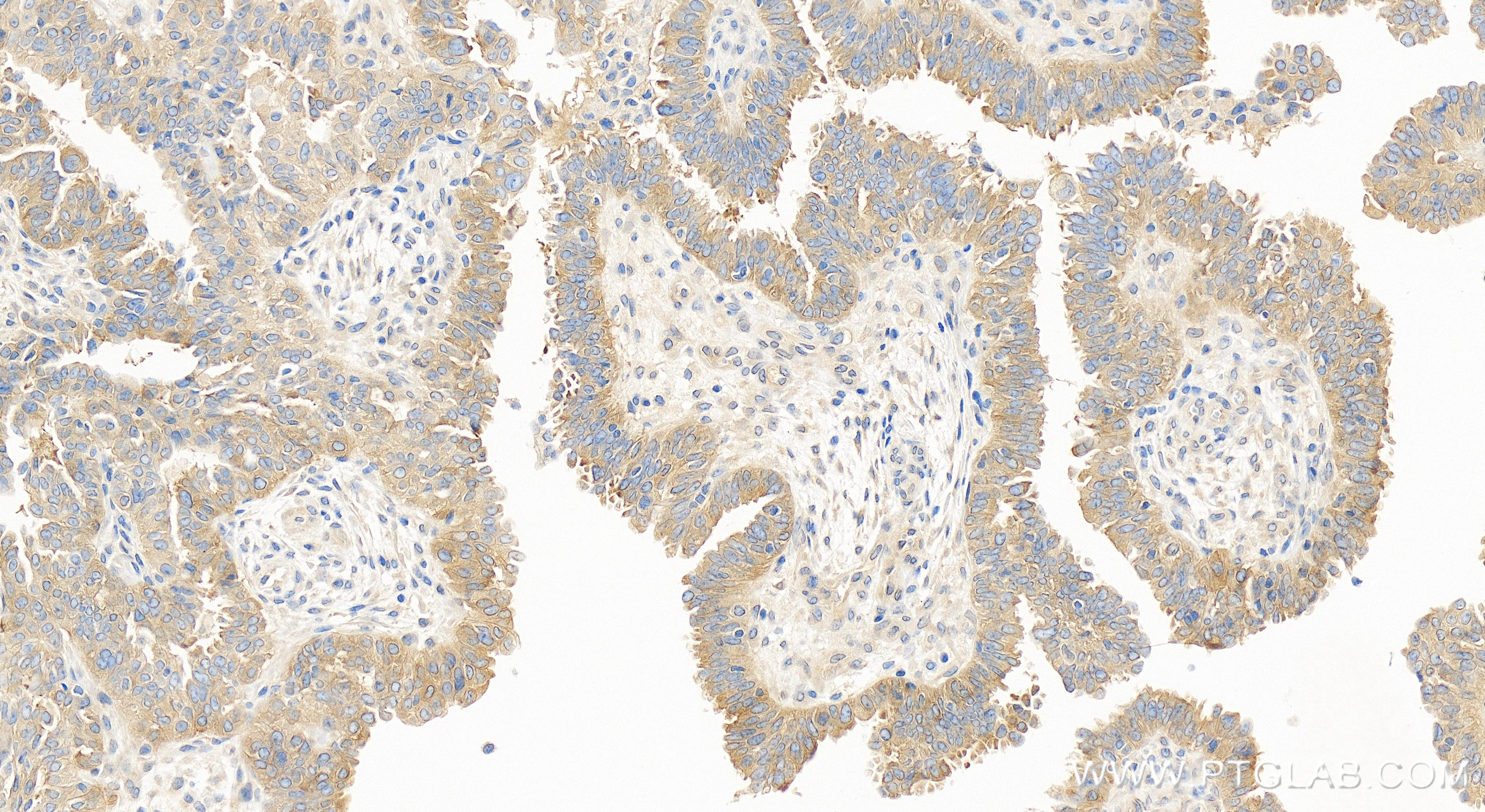 IHC staining of human ovary cancer using 84204-5-RR (same clone as 84204-5-PBS)