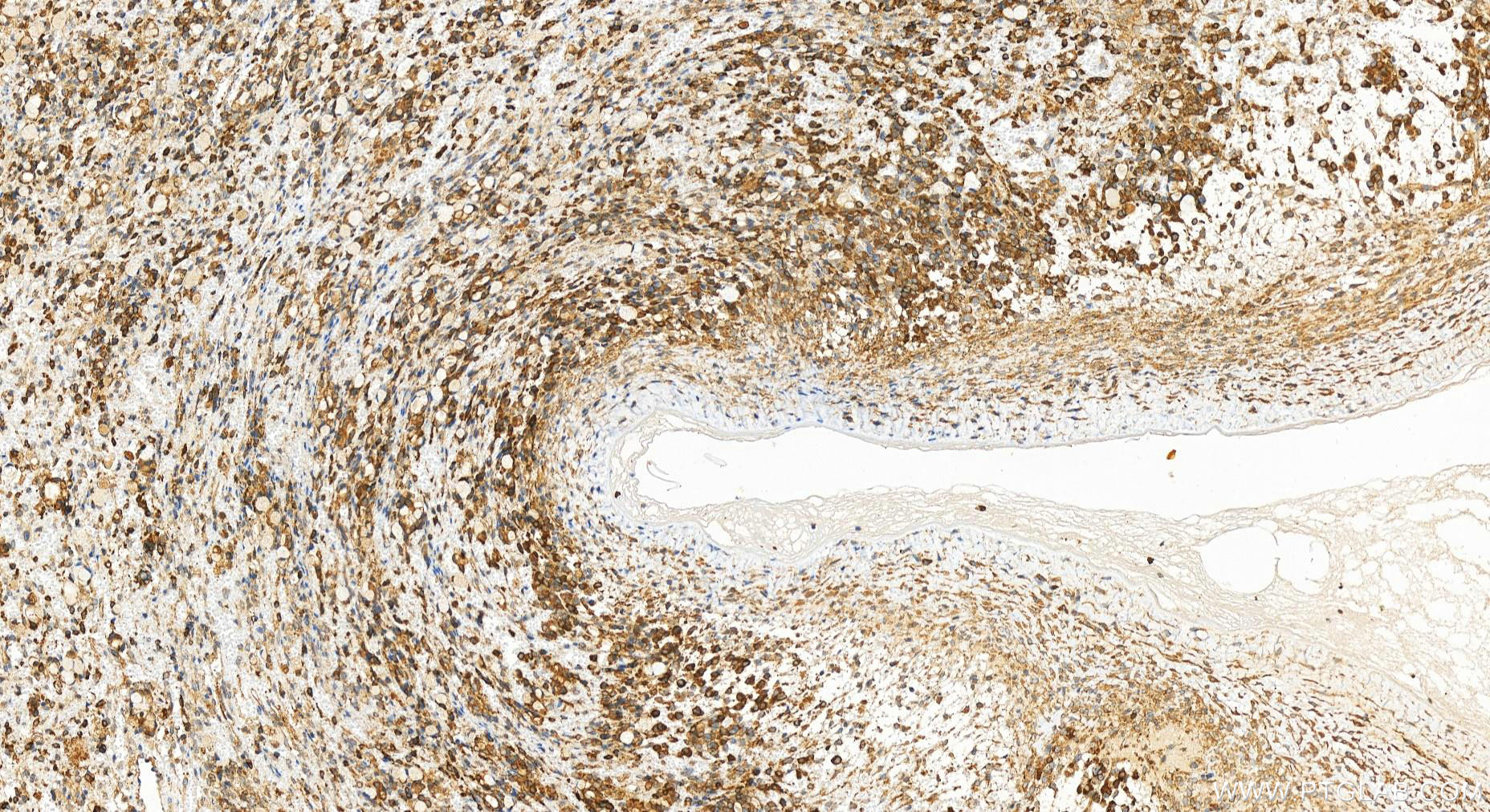 IHC staining of human ovary cancer using 18138-1-AP