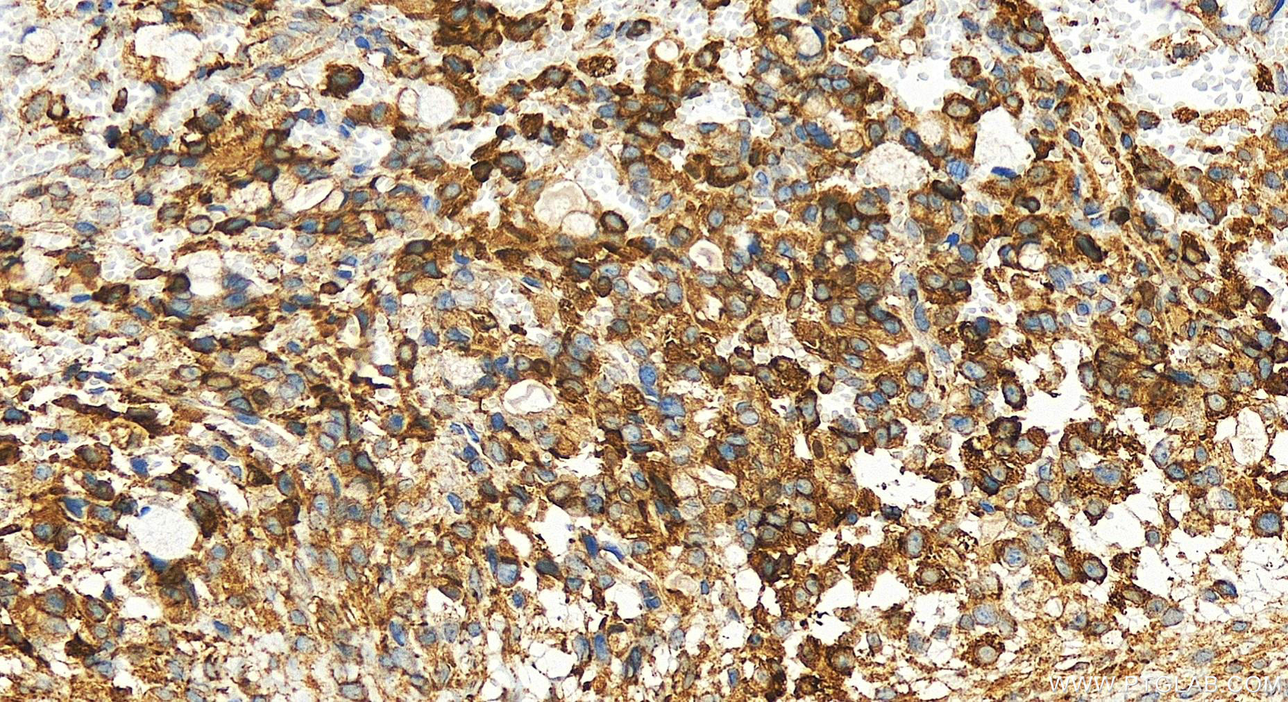 IHC staining of human ovary cancer using 18138-1-AP