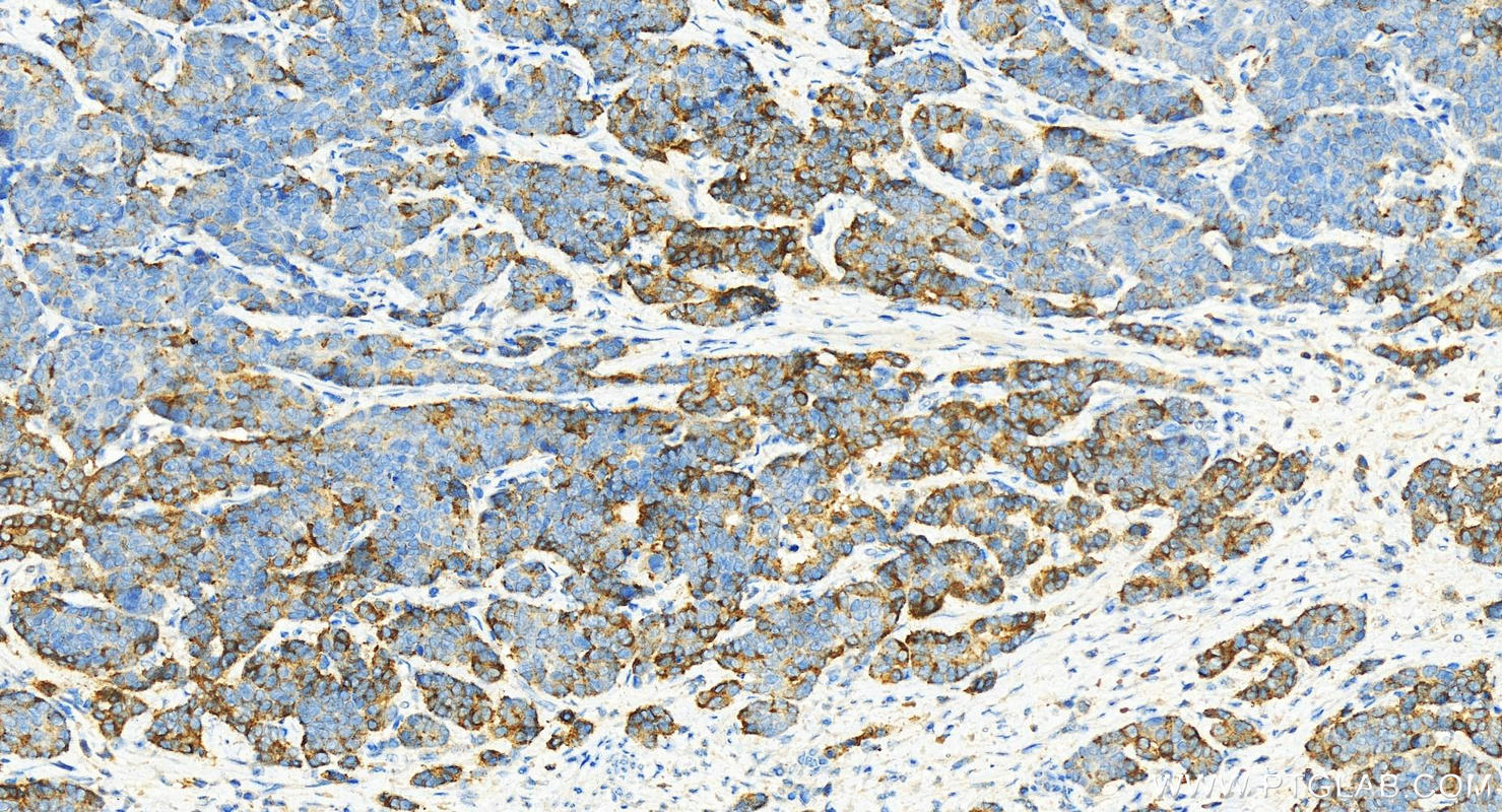 IHC staining of human stomach cancer using 13950-1-AP