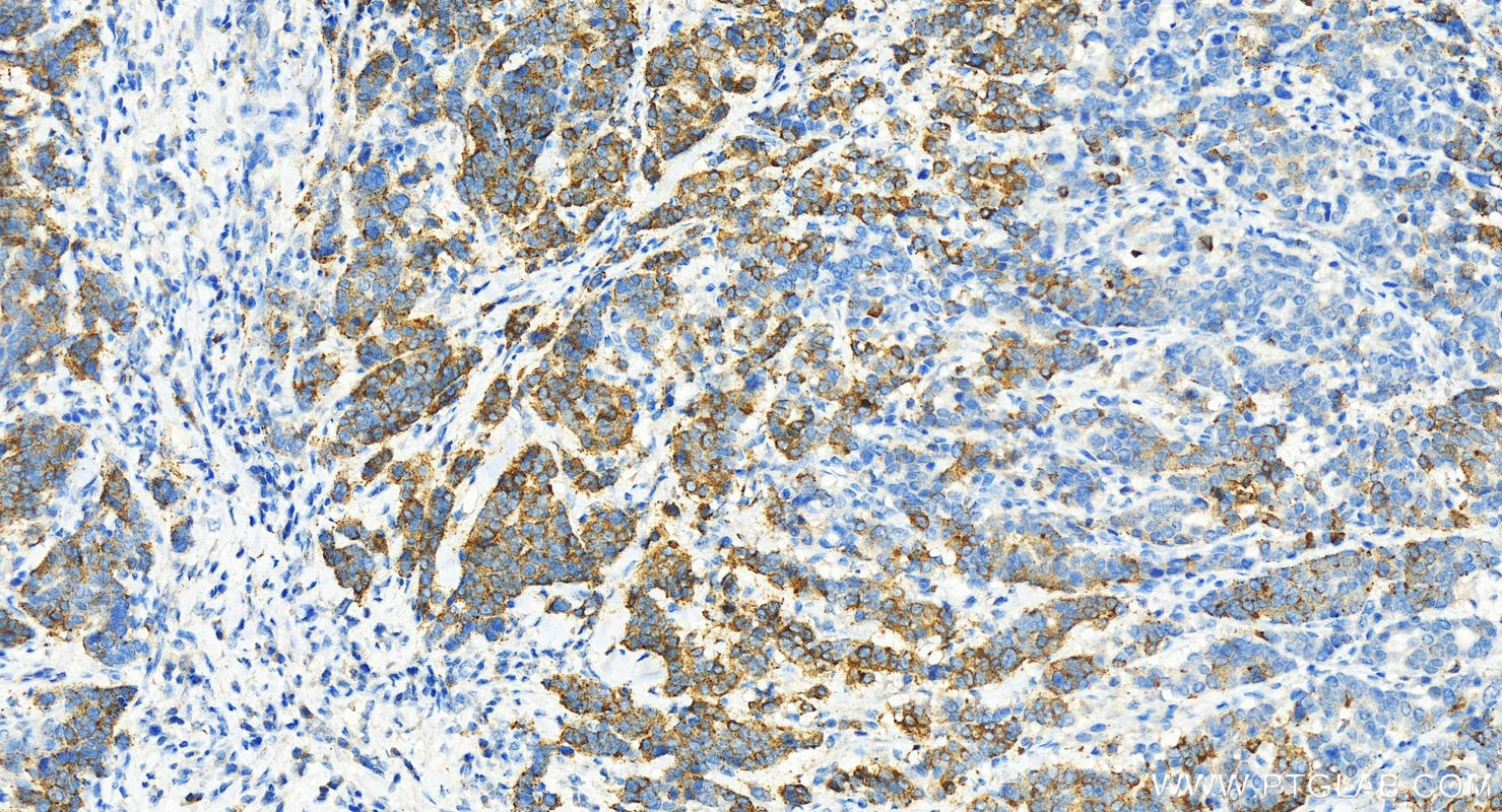 IHC staining of human stomach cancer using 13950-1-AP