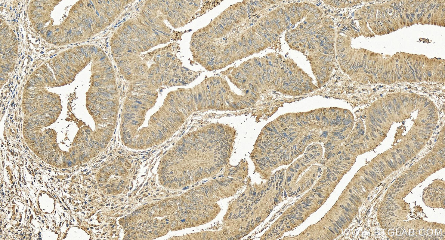 IHC staining of human colon cancer using 10226-1-AP