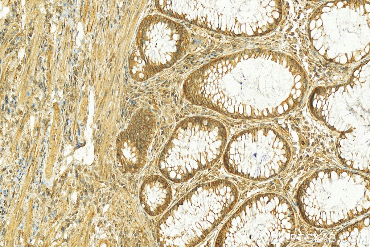 IHC staining of human colon cancer using 16338-1-AP