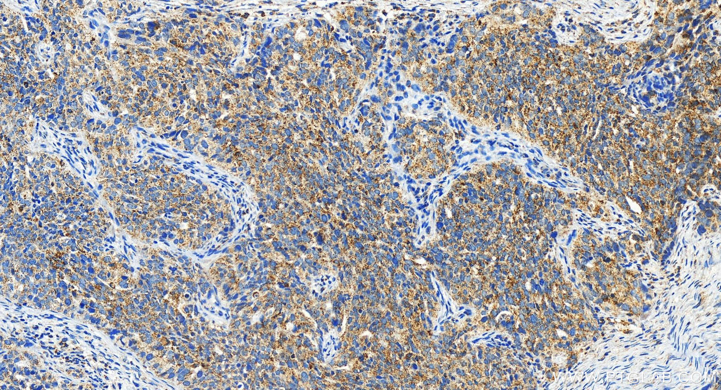 IHC staining of human ovary cancer using 21080-1-AP