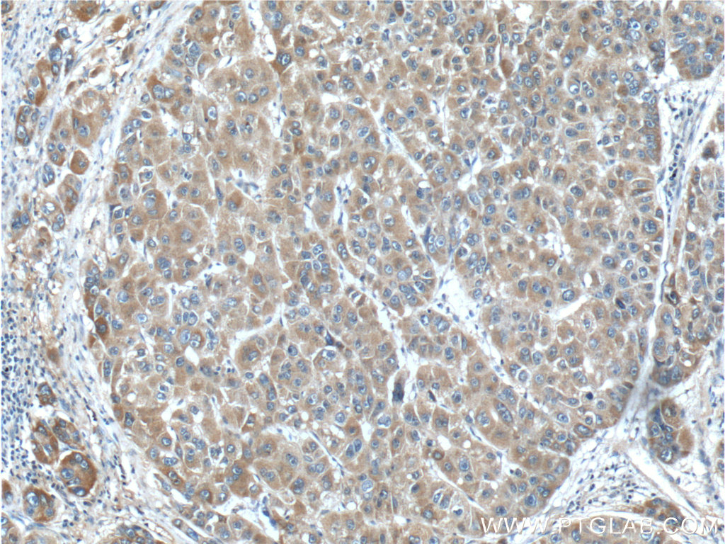 IHC staining of human liver cancer using 17871-1-AP