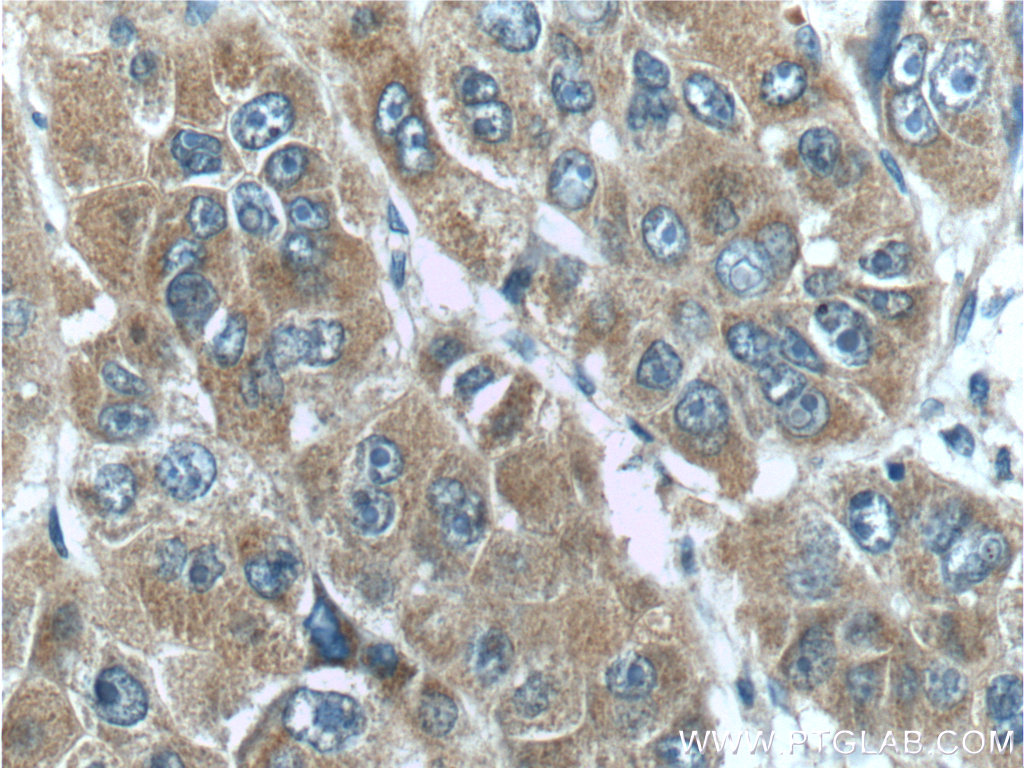 IHC staining of human liver cancer using 17871-1-AP