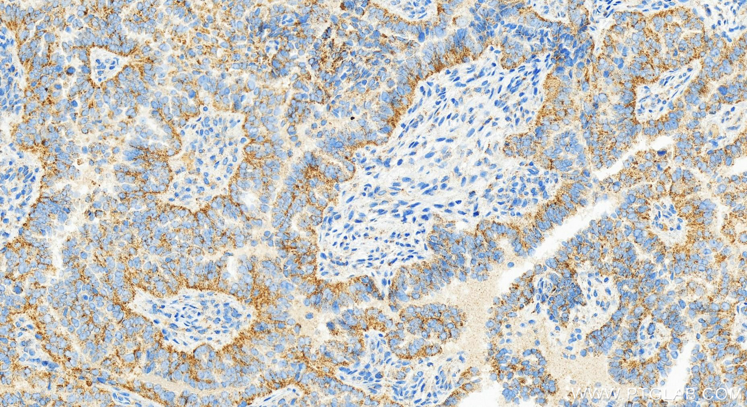 IHC staining of human ovarian  cancer using 83731-1-RR