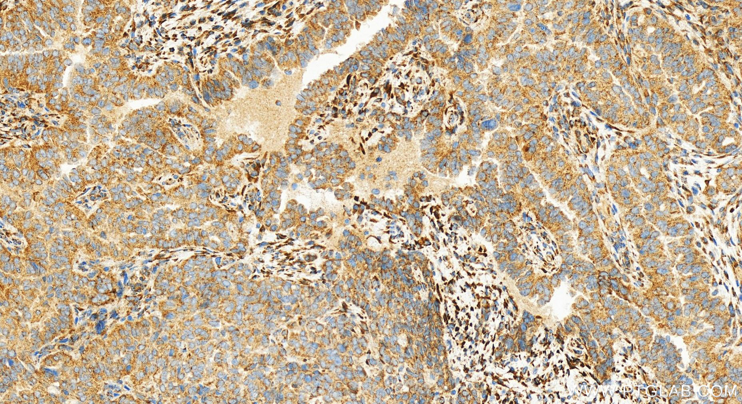 IHC staining of human ovarian  cancer using 83731-2-RR