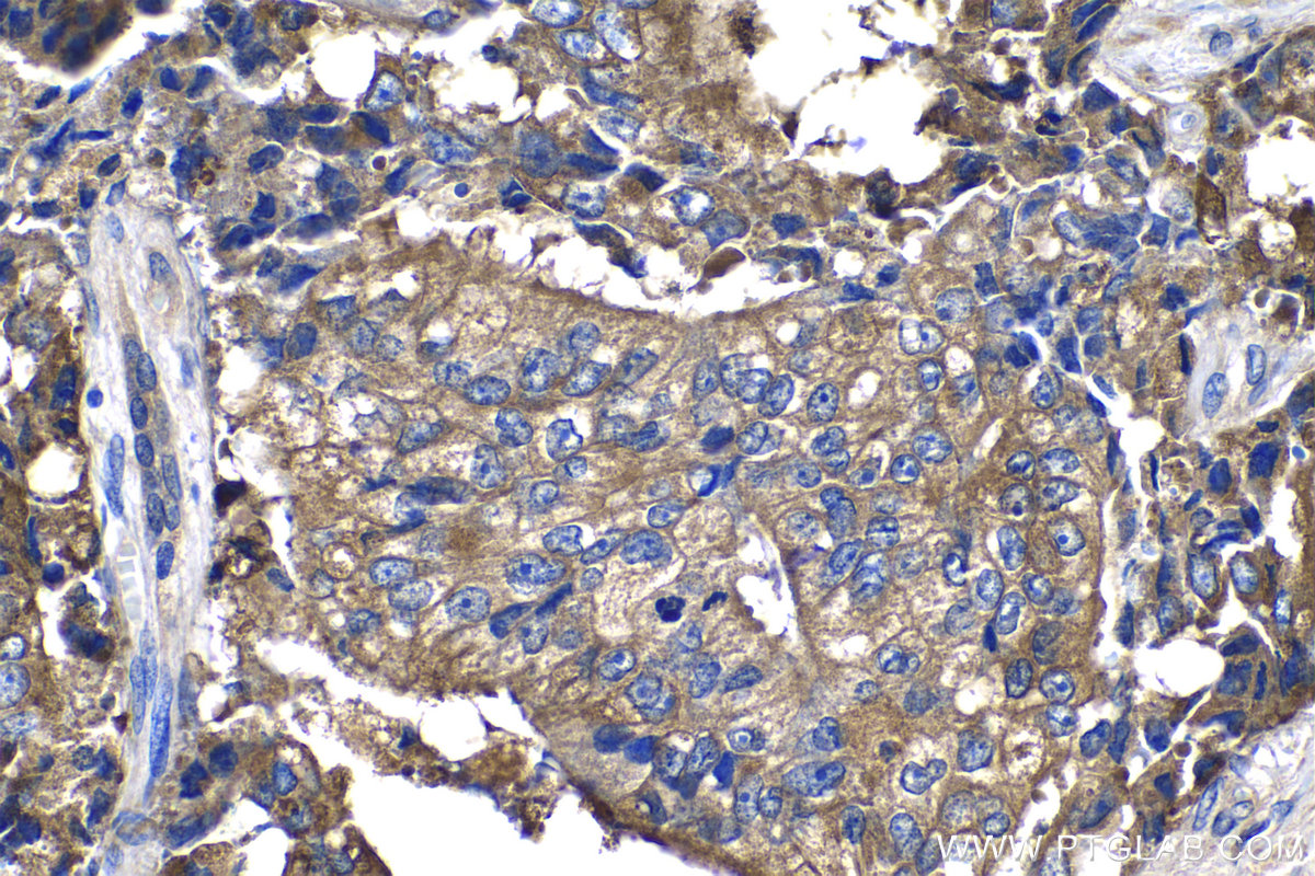 IHC staining of human prostate hyperplasia using 60176-1-Ig (same clone as 60176-1-PBS)