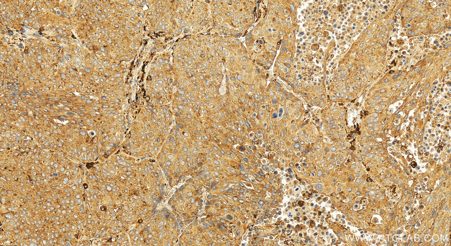 IHC staining of human lung squamous cell carcinoma using 13989-1-AP