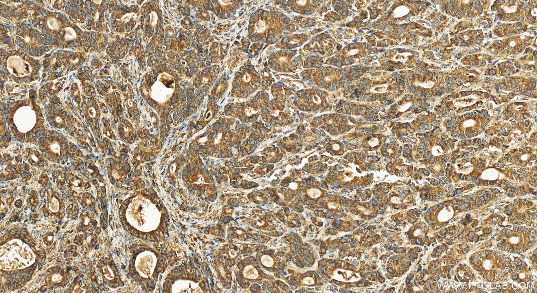 IHC staining of human stomach cancer using 20710-1-AP