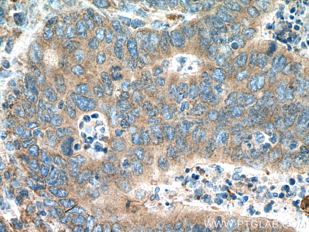 IHC staining of human colon cancer using 10168-2-AP