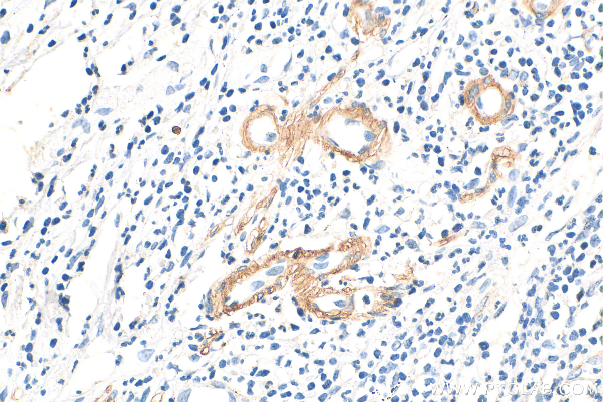 IHC staining of human appendicitis using 14395-1-AP