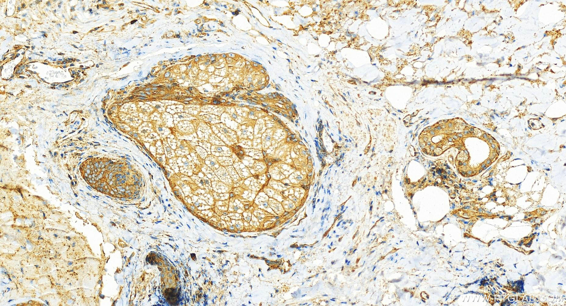 IHC staining of human skin cancer using 11227-1-AP