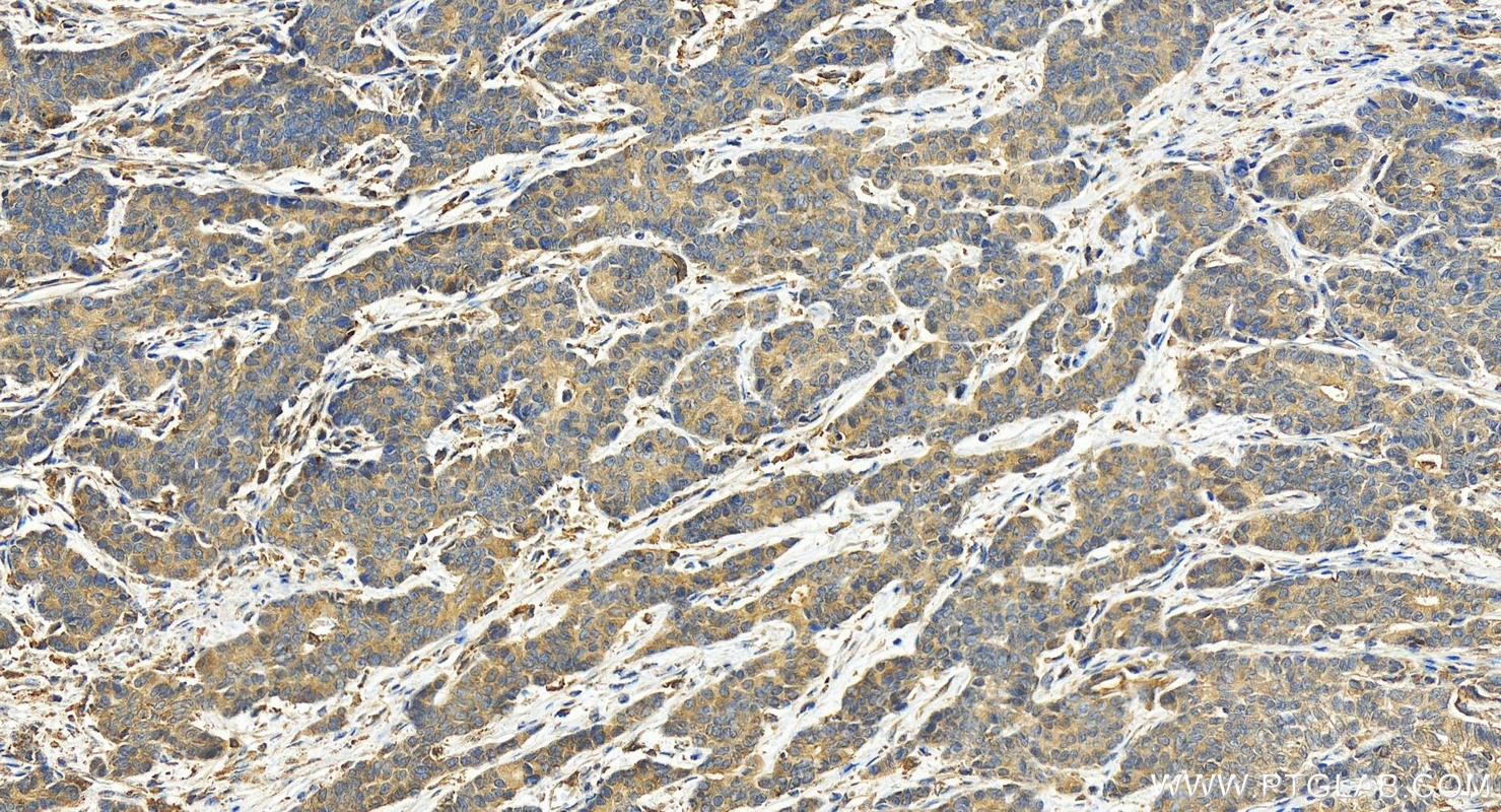 IHC staining of human stomach cancer using 17022-1-AP