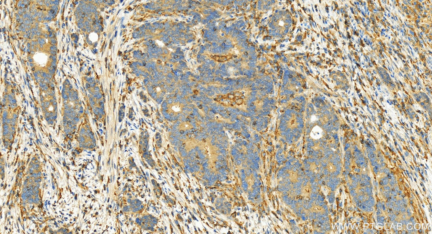 IHC staining of human stomach cancer using 17022-1-AP