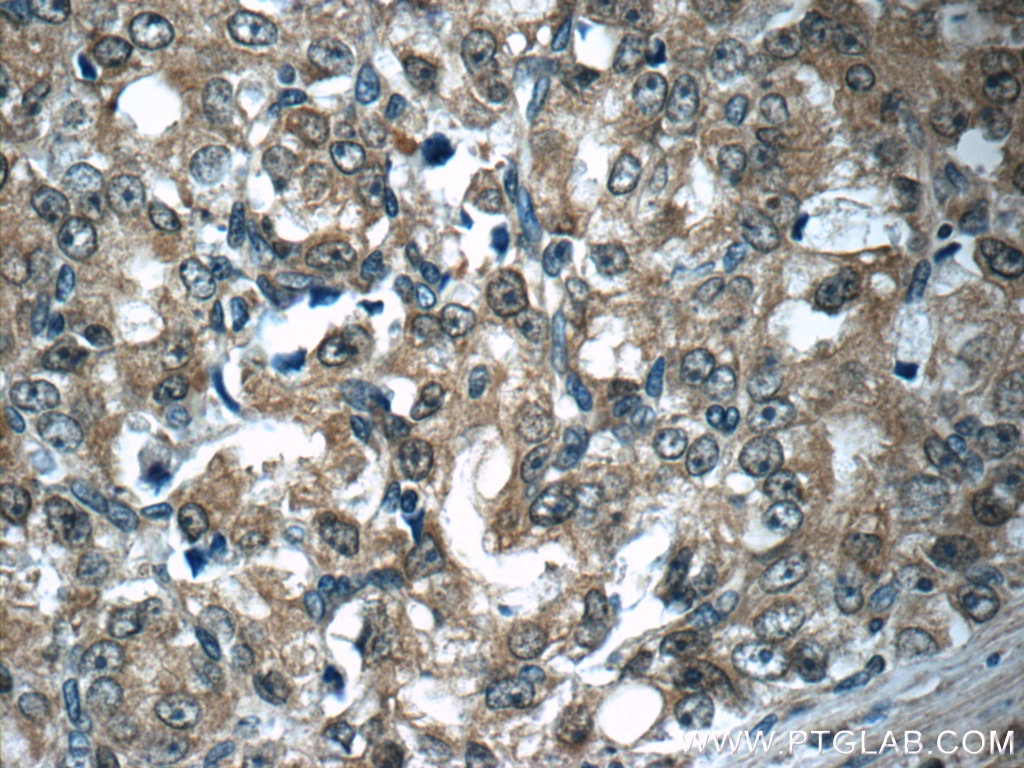 IHC staining of human prostate cancer using 11316-1-AP