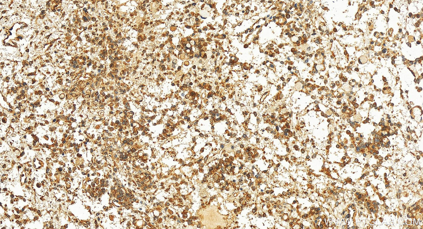 IHC staining of human ovary cancer using 17579-1-AP