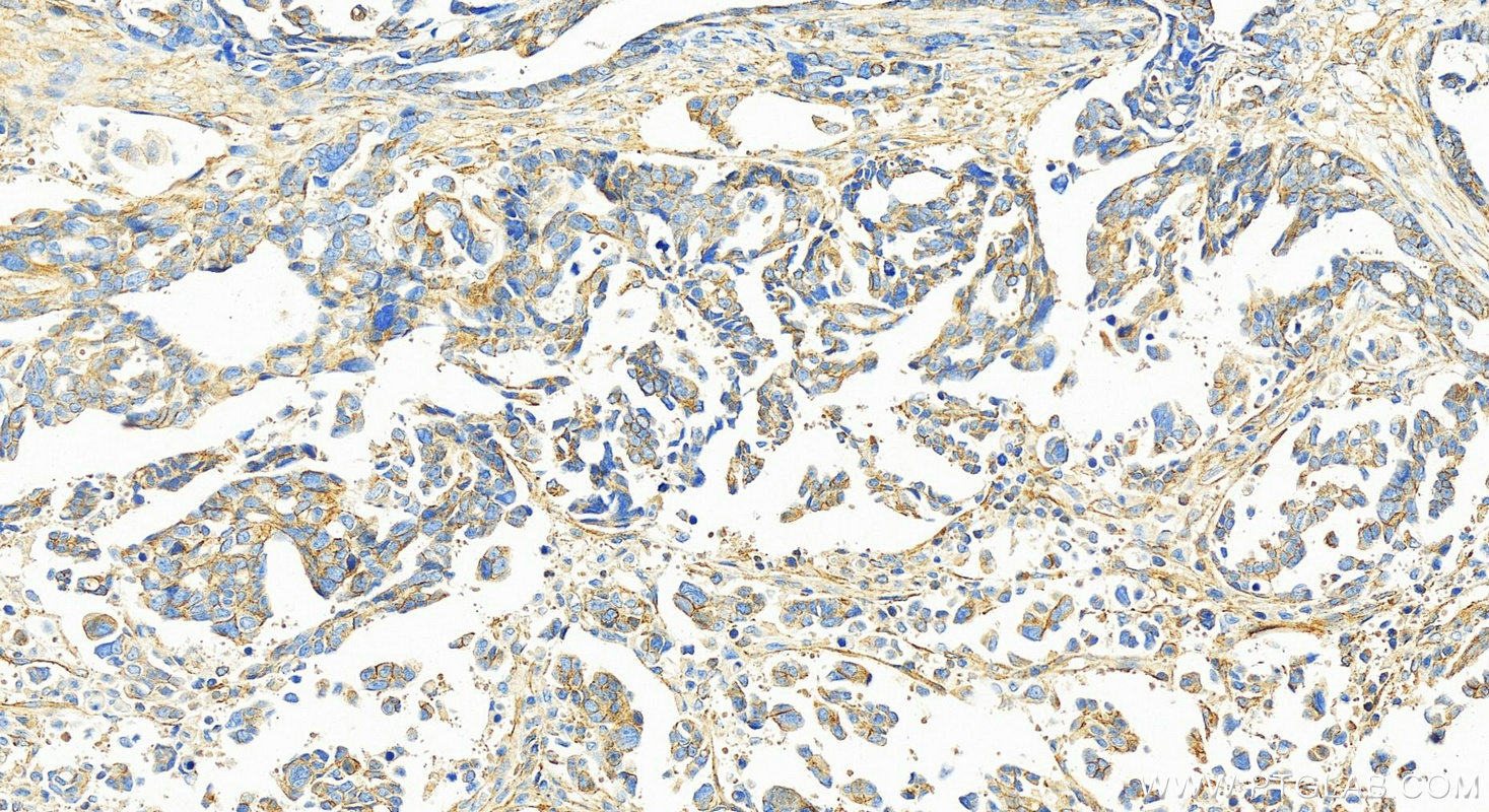 IHC staining of human ovary cancer using 10791-1-AP