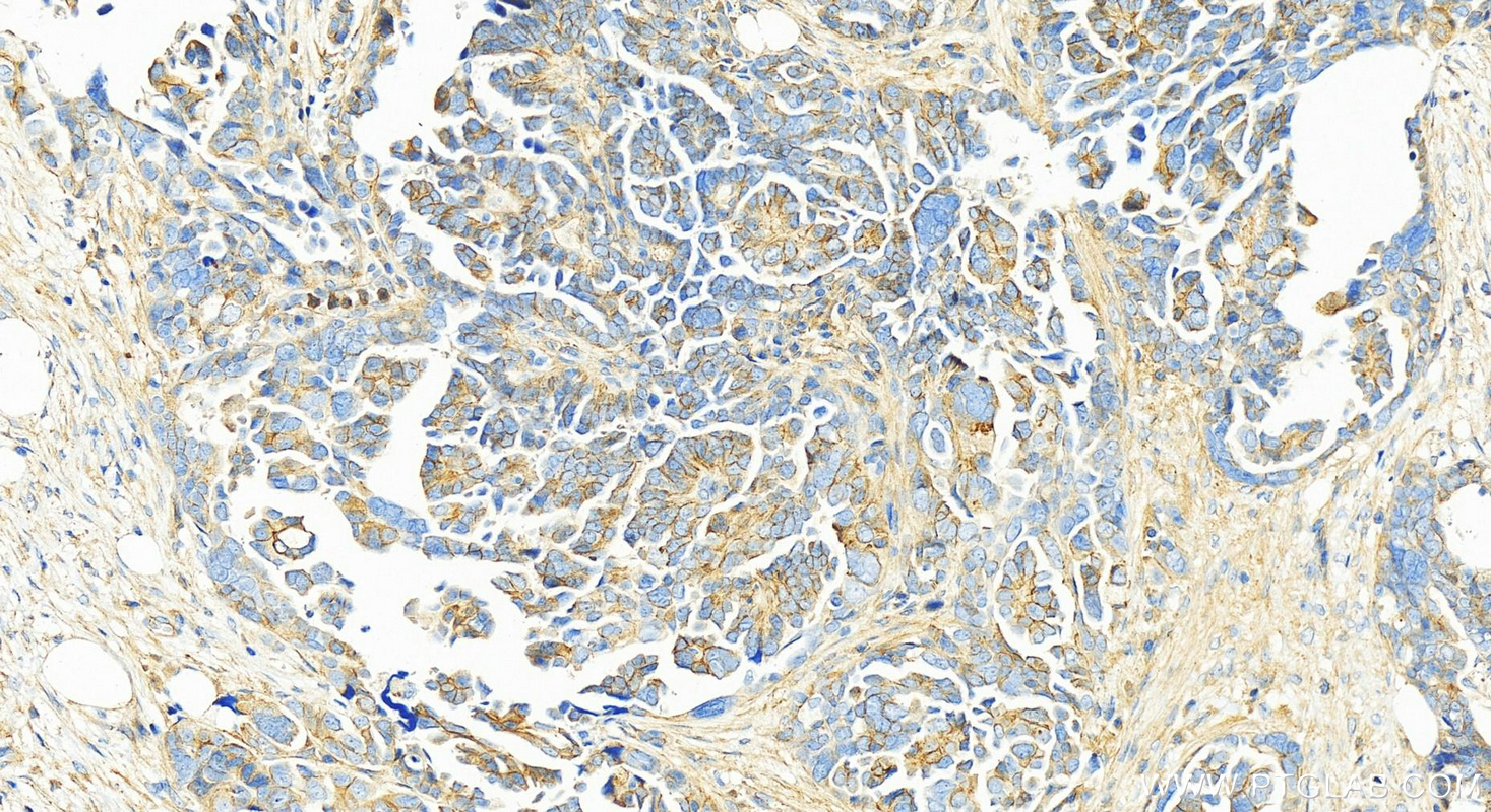 IHC staining of human ovary cancer using 10791-1-AP