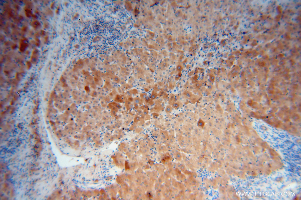 IHC staining of human liver cancer using 15264-1-AP