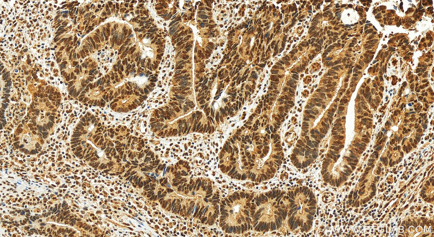 IHC staining of human rectal cancer using 68592-1-Ig