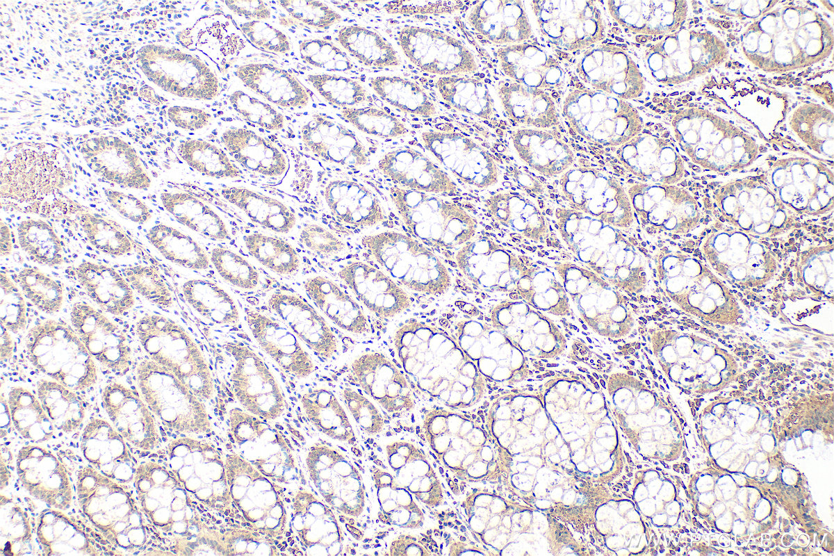 IHC staining of human rectal cancer using 68592-1-Ig