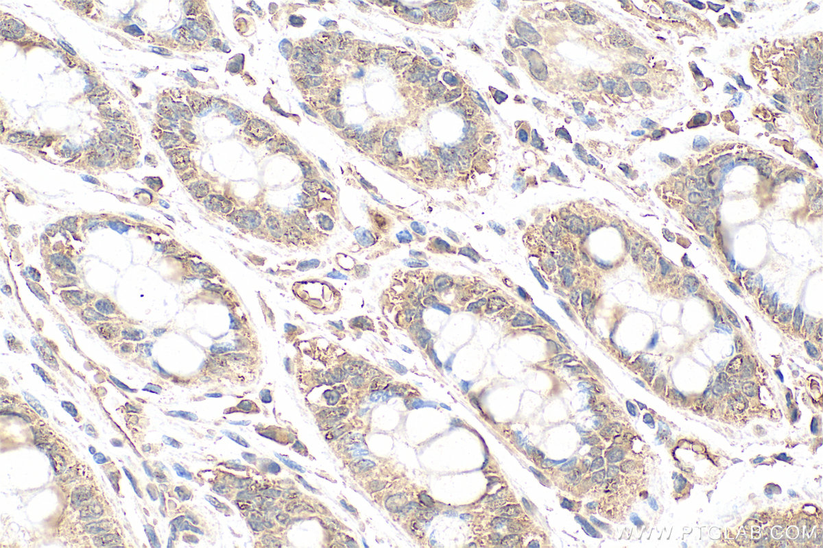 IHC staining of human rectal cancer using 68592-1-Ig