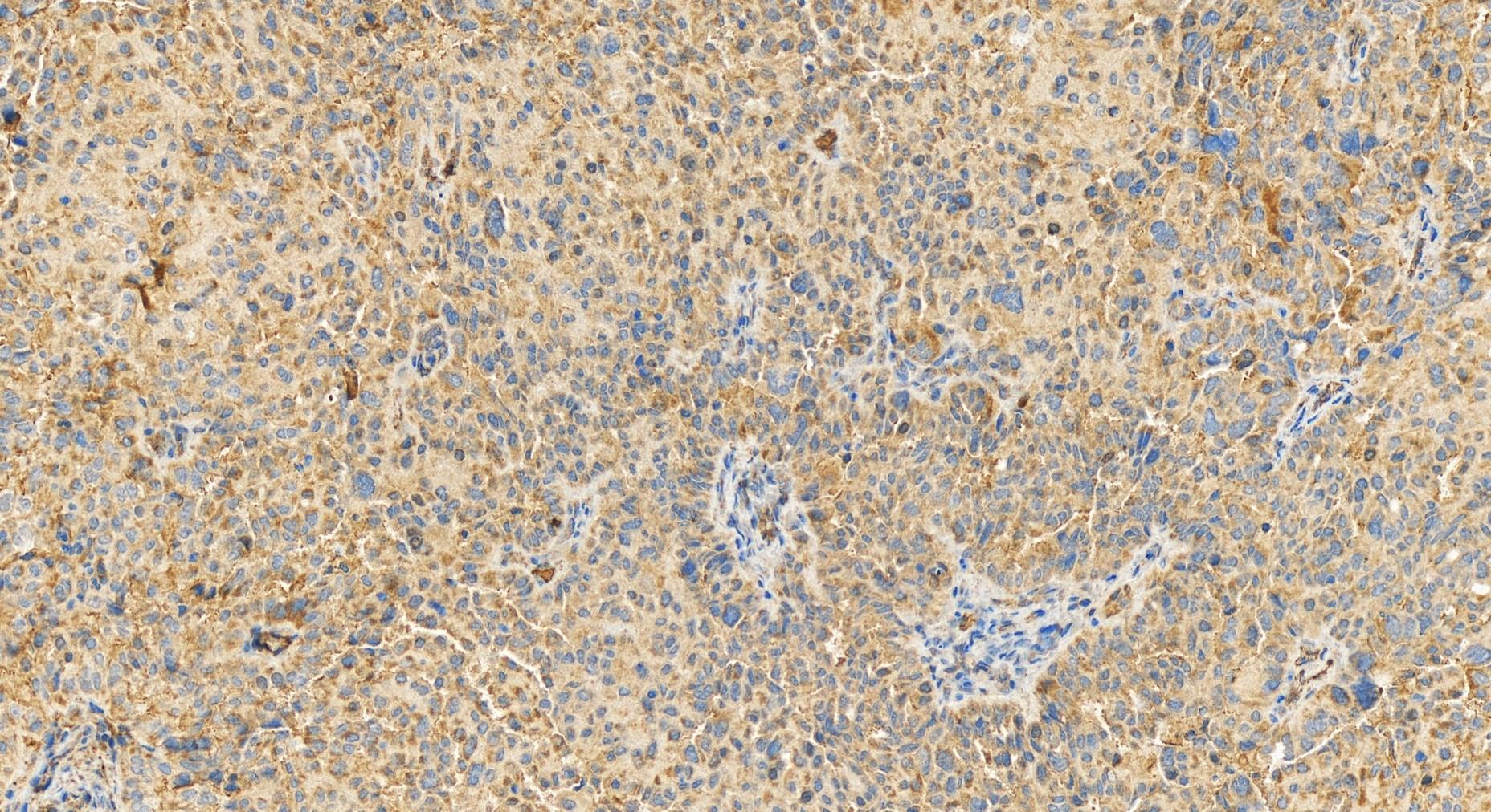 IHC staining of human ovary cancer using 14550-1-AP