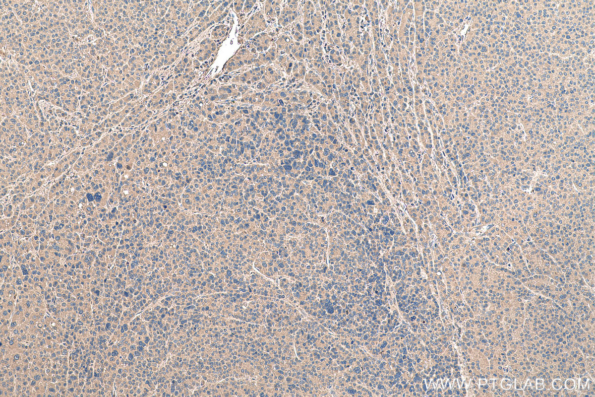 IHC staining of human liver cancer using 67852-1-Ig