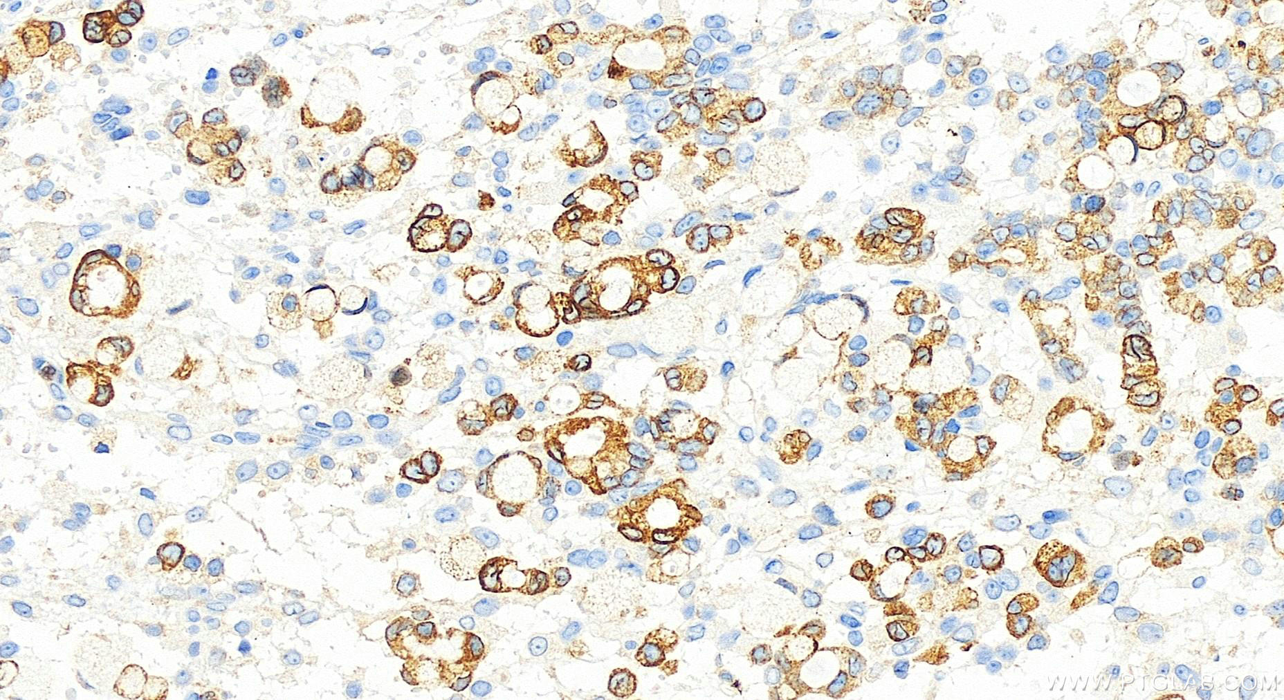 IHC staining of human ovary cancer using 83349-3-RR