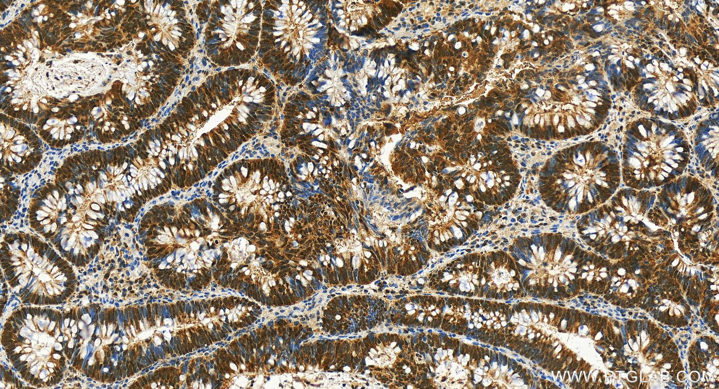 IHC staining of human colon cancer using 10757-2-AP