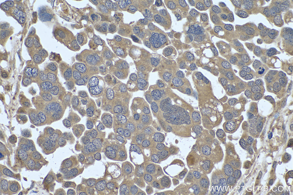 IHC staining of human colon cancer using 66019-1-Ig (same clone as 66019-1-PBS)