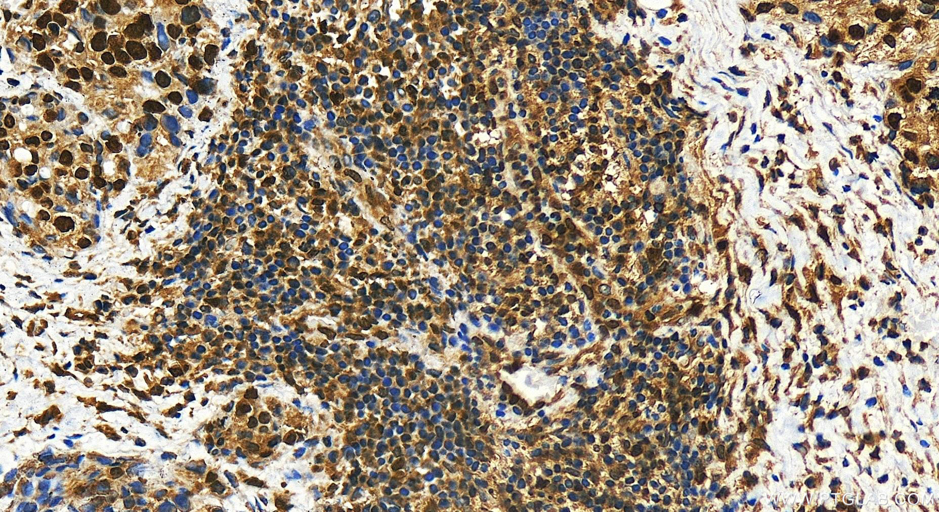 IHC staining of human ovary cancer using 30242-1-AP (same clone as 30242-1-PBS)