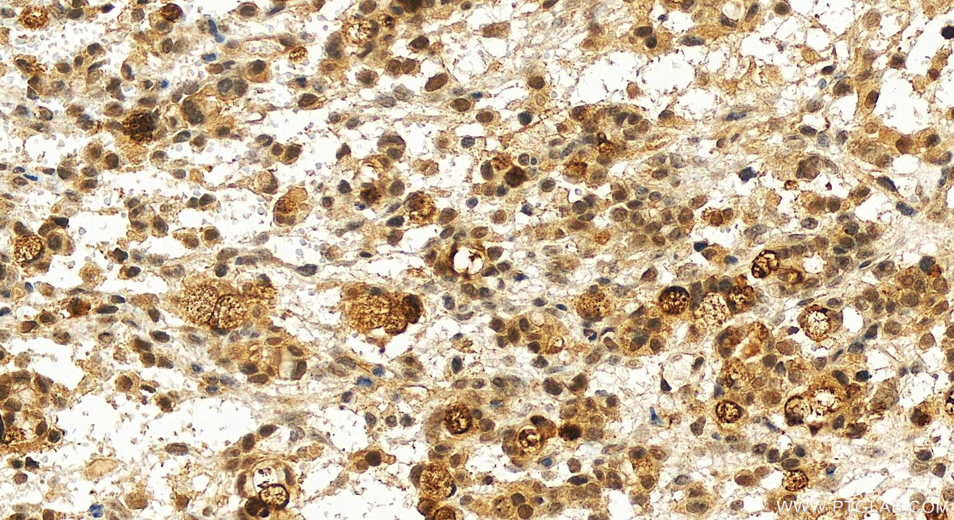 IHC staining of human ovary cancer using 83369-5-RR (same clone as 83369-5-PBS)