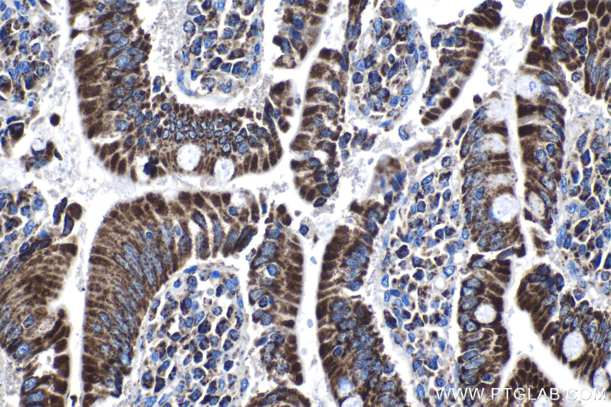 IHC staining of human stomach cancer using 67791-1-Ig