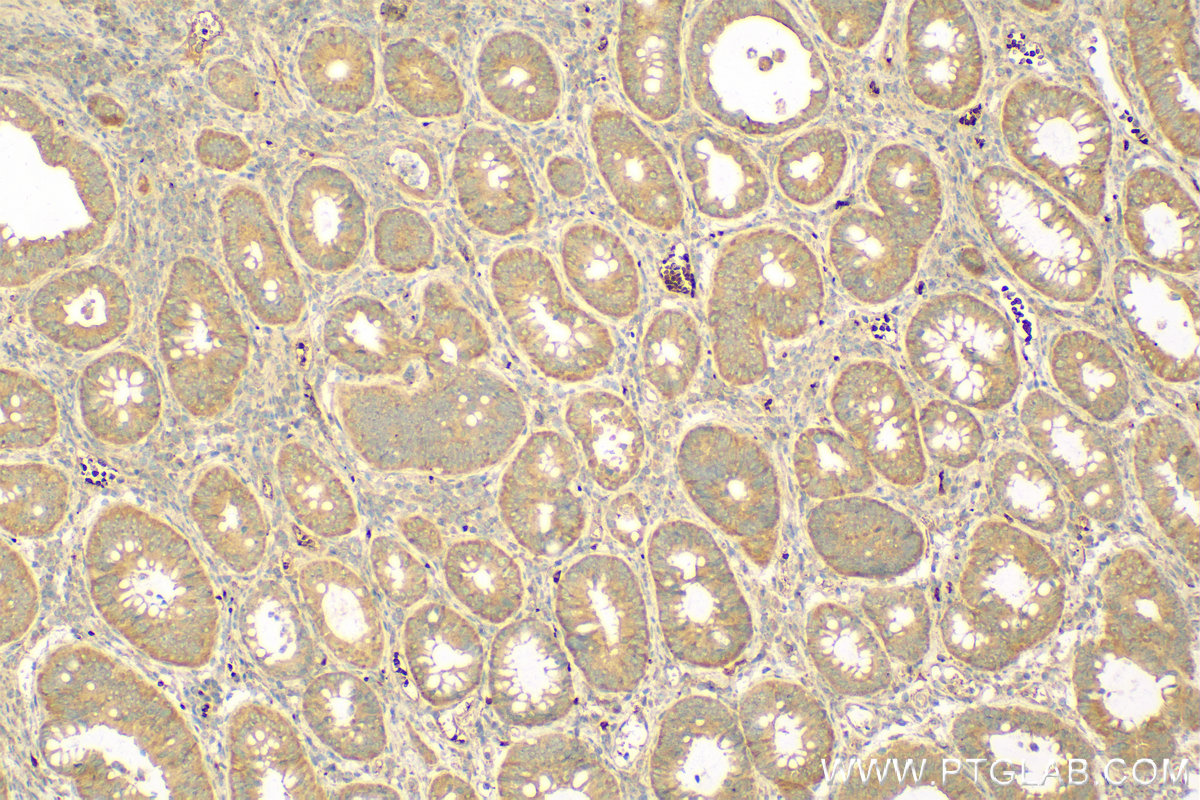 IHC staining of human colon cancer using 14778-1-AP