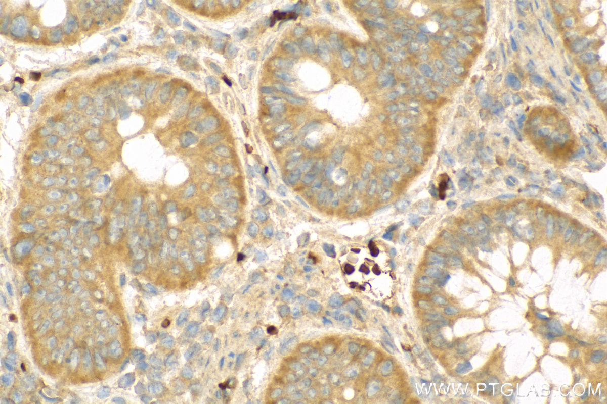 IHC staining of human colon cancer using 14778-1-AP