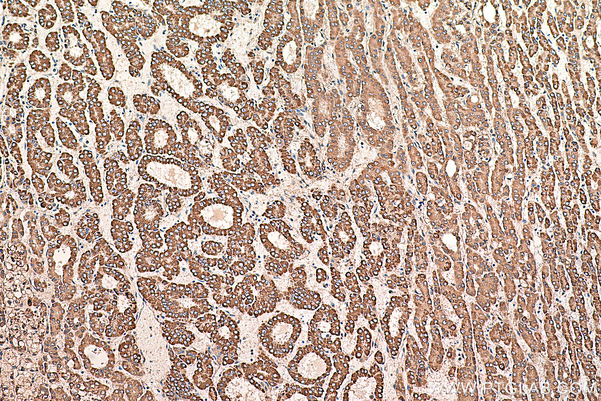 IHC staining of human liver cancer using 66127-1-Ig (same clone as 66127-1-PBS)