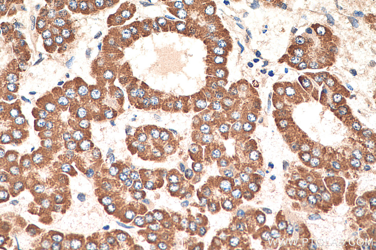 IHC staining of human liver cancer using 66127-1-Ig (same clone as 66127-1-PBS)