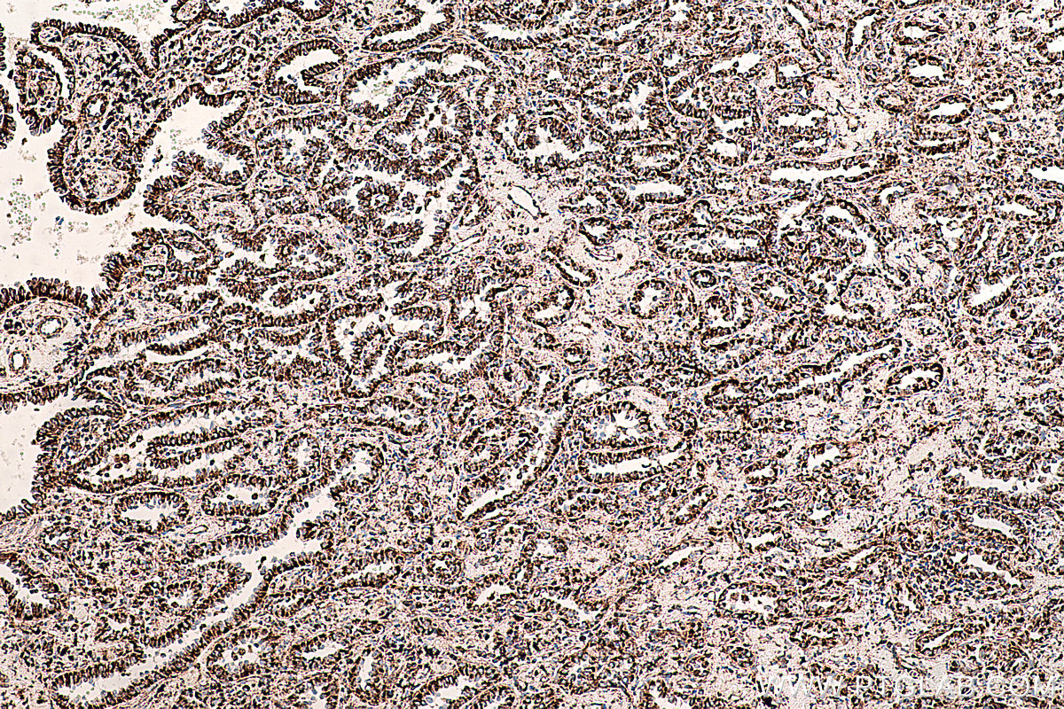 IHC staining of human lung cancer using 66127-1-Ig (same clone as 66127-1-PBS)