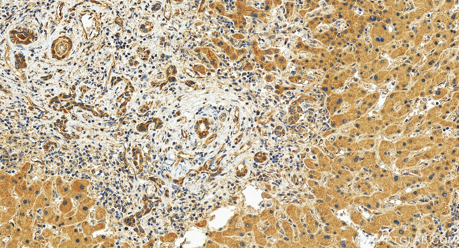 IHC staining of human intrahepatic cholangiocarcinoma using 30552-1-AP